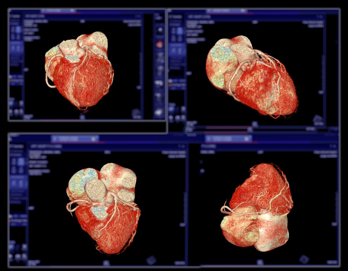 Tecnología cardiovascular CardioBit — imagen médica especializada