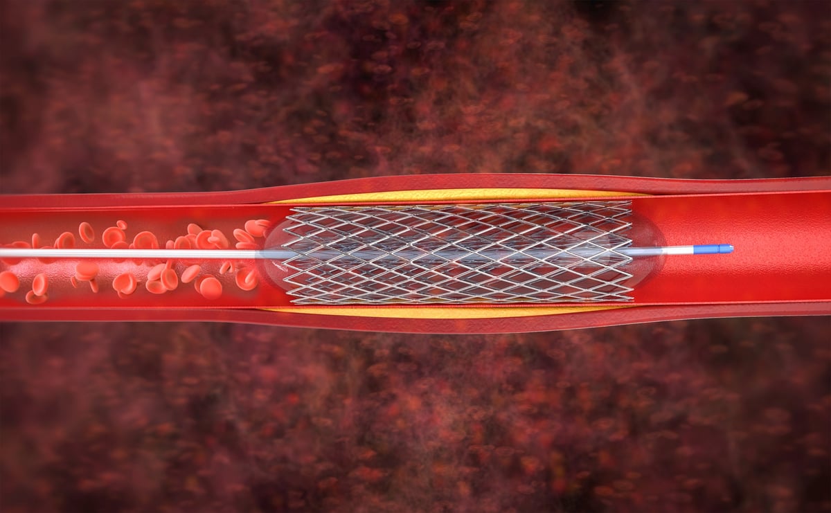 Representación de procedimiento de angioplastia con balón y stent
